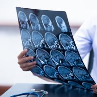 young female doctor holding MRI or CT scan picture, doctor in uniform sitting in working room and holding X-ray picture for diagnosis brain injury or cerebrovascular accident of patient