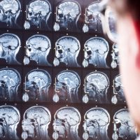 MRI scan of head and brain. Doctor in foreground with blurred silhouette looks at magnetic resonance imaging of brain of patient in background in focus. Concept image in neurology or neurosurgery